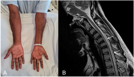 Reverse split hand syndrome and distinctive magnetic resonance imaging features in Hirayama disease. (A) The examination is notable for marked wasting over the left forearm and hand muscles with sparing of the brachioradialis. Reverse split hand syndrome due to dissociated atrophy of the abductor digiti minimi compared to the abductor policis brevis is seen. (B) T2-weighted sagittal MRI image in flexion shows anterior displacement of the posterior dura and prominent posterior epidural space with flow voids.