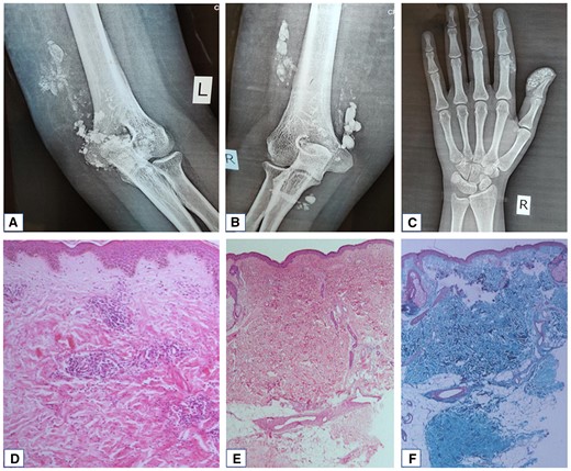 Plain radiographs showing soft tissue calcification around left elbow (A), right elbow (B) and right first and second fingers (C) consistent with calcinosis cutis. Histopathology of skin showing focally atrophic dermis with mild perivascular lymphocytic infiltrates in superficial and deep dermis (D, 100×, hematoxylin and eosin), areas of sclerosis representing healed panniculitis (E, 400×, hematoxylin and eosin), better highlighted on Masson’s trichrome stain (F).