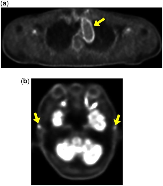 (a) PET/CT showed hyperaccumulation in the thoracic aorta (yellow arrow). (b) PET/CT showed hyperaccumulation in the bilateral temporal arteries (yellow arrows).