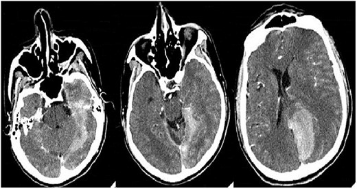 Control brain computed tomography shows the extension of the hyperdense lesion with left occipital-temporal parenchymal hemorrhage, with ventricular breakthrough and midline deviation.