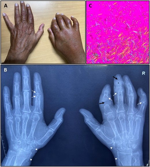 Clinical photograph of both hands (A) showing short right index finger with tophaceous deposits; hand radiograph (B) showing well-defined ‘punched-out’ erosions with sclerotic margins and overhanging bony edges (white arrow), osteolysis of phalanx (black arrow), tophaceous deposits with calcification (asterisk) and vascular calcification (arrow head); and polarized microscopy (C) showing monosodium urate crystals.