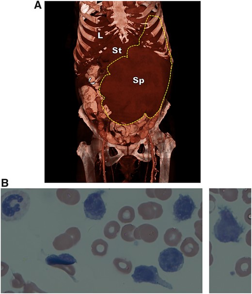 (A) 3D reformation of contrast-enhanced computed tomography (CECT) of the abdomen and pelvis, showing a gigantic spleen (SPL; borders demarcated by broken line) dwarfing the liver (L), compressing the stomach (G) and left kidney and displacing the liver and many bowel loops. The curved arrow points to the edge of a nasogastric tube. (B) Peripheral blood smear (Giemsa, X100) showing abnormal lymphoid cells with characteristic surface villous projections and a clumped chromatin.