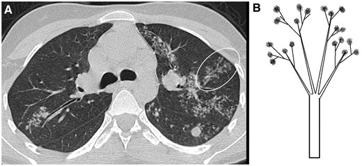 Computed tomogram of the chest showing thickened terminal airways in branching pattern along with centrilobular nodules (encircled area in A). It is called the ‘tree-in-bud’ appearance as it is likened to a tree with budding branches (B).