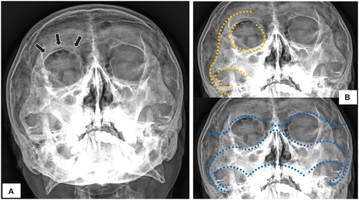 Plain radiography of Water’s view (A) showing black eyebrow sign (arrows); (B) depicting the elephantine lines of Dolan (upper panel) and McGrigor’s lines (lower panel).