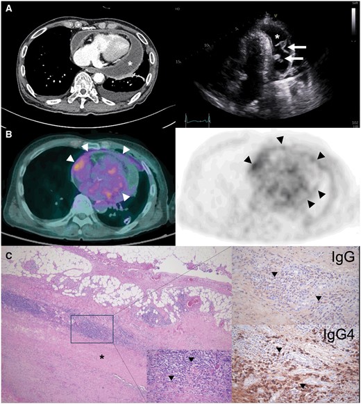 (A) Chest computed tomography and echocardiography showing a moderate amount of pericardial effusion (white asterisks) with pericardial thickening and fibrinous strands (arrows). (B) 18F-fluorodeoxyglucose-positron emission tomography scan showing diffusely increased uptake (arrowheads) in the pericardium. (C) The pericardial biopsy specimen demonstrating dense fibrosis of the pericardium (black asterisks) and infiltration of lymphoplasmacytic cells (arrowheads) (middle bottom, hematoxylin & eosin) stained brown by IgG and IgG4 with an IgG4/IgG cell ratio of ∼50%.