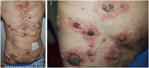 Lesions on the trunk and thighs, manifested as unevenly sized erythematous patches, with rupioides papules visible at the center of the patches.