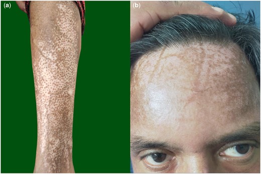 (a) Salt-and-pepper pigmentation over legs with sparing of pigmentation along superficial veins. (b) Pigment sparing over the course of superficial veins within areas of salt-and-pepper pigmentation on the forehead and scalp.