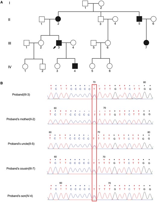 (A) The pedigree of thyroid hormone resistance syndrome. The proband was indicated by the black arrow. (B) Sanger sequencing validated the compound heterozygous variants of c.1358C>T in the proband (III-3), his mother (II-2), his uncle (II-5), his cousin (III-7) and his son (IV-4). The variant sites were marked by the red pane.