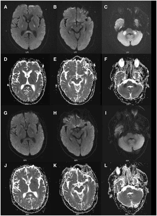 Initial brain MRI scans and repeated brain MRI scans. Initial brain MRI showed prominent hyperintensities on diffusion-weighted imaging (A–C) with decreased apparent diffusion coefficient values (D–F) and mild T2 hyperintensities (not shown) in the splenium of corpus callosum, and bilateral posterior limb of internal capsule, cerebral peduncles and middle cerebellar peduncles, indicating cytotoxic edema. A follow-up brain MRI after 2 weeks demonstrated near-complete resolution of abnormalities on diffusion-weighted imaging (G–I) and apparent diffusion coefficient mapping (J–L).