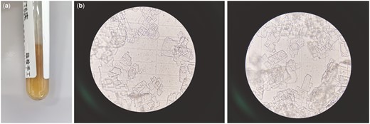 (a) Appearance of the first pleural fluid, which was yellow and celiac in color.(b) Shows the electron microscope image under 40 × 40 high magnification, which is characterized by ‘square or irregular square’.