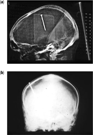 Tomographic (a) and frontal skull X-ray (b) views of patient A, showing a nail embedded through the skull into the brain. Note the translucency surrounding the nail in image a, which represents abscess formation.