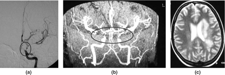 Patient 8, a 26 year old female, with hemiparesis and aphasia due to middle-sized vessel PACNS. (a) Selective left internal carotid angiography: severe stenosis of the distal internal carotid artery, proximal anterior and middle cerebral arteries, progressing 7 days later with similar lesions on the right. (b) MR angiography. (c) Limited left hemisphere abnormalities on T2-weighted MR scan.