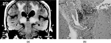 (a) The pulvinar sign, patient 5, coronal flair image: generally considered diagnostic of new variant Creutzfeldt-Jakob disease, presenting in acute small-vessel PACNS encephalopathy in a 53-year-old female. White matter ischaemic changes in both hemispheres are also present. (b) Brain biopsy from patient 5, showing fibrinoid necrosis with small-vessel vasculitis.
