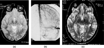 Patient 2, a 22 year old female receiving the oral contraceptive pill, presenting with grand mal convulsions due to small-vessel PACNS. (a) MR scan, axial T2-weighted tubular spin echo (TSE) showing diffuse grey and white matter ischaemic lesions. (b) Direct cerebral angiography showing no evidence of vascular occlusions, but contrast pooling, capillary blush apparent during the venous phase. (c) MR scan, during relapse 4 years later, with widespread severe ischaemic injuries.