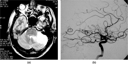 Patient 10, a 49 year old male, presenting with cerebellar infarct due to middle-sized vessel PACNS. (a) MR T2-weighted fast spin echo showing left cerebellar signal change only. (b) Direct cerebral angiography filling only of the right posterior inferior cerebellar artery, left absent; narrowing of the distal basilar artery due to vasculitis; other abnormalities encircled. The cerebral angiogram revealed multiple vessels showing characteristic MVD vasculitis, several without MR scan abnormalities in corresponding territories.