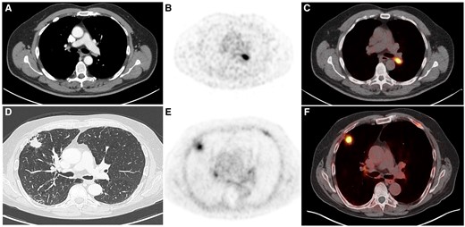 Pathologic outcome of incidentally detected tracer-avid lesions in 68Ga ...