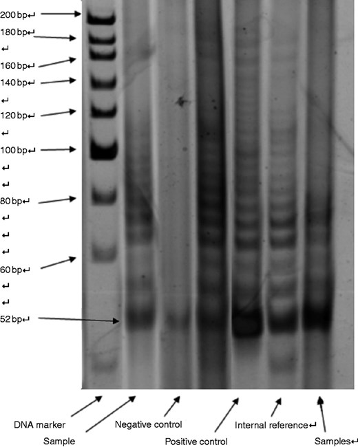 Telomerase activity is more significant for predicting the outcome of ...