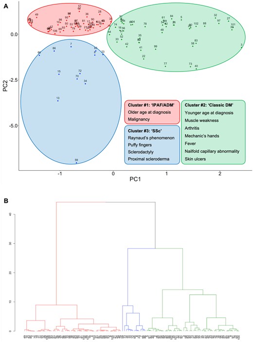 Unsupervised clustering using the SMCE cohort. (A) Factor map depicting the result of MCA. (B) Dendrogram generated by hierarchical clustering. The colours indicate the clusters to which each case belongs