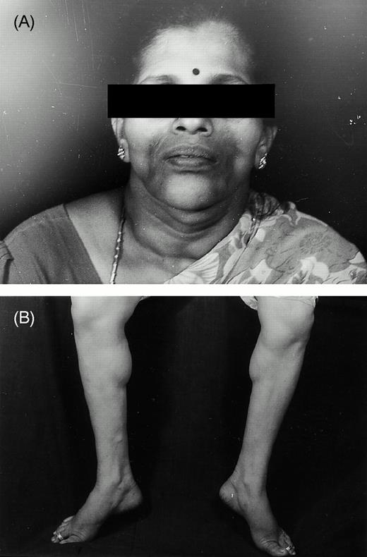 (A) The face of a patient with lipodystrophy reveals the loss of adipose tissue and bony and muscular contours are seen. (B) The patient's calves demonstrate the muscular contours demarcated due to the loss of fat.