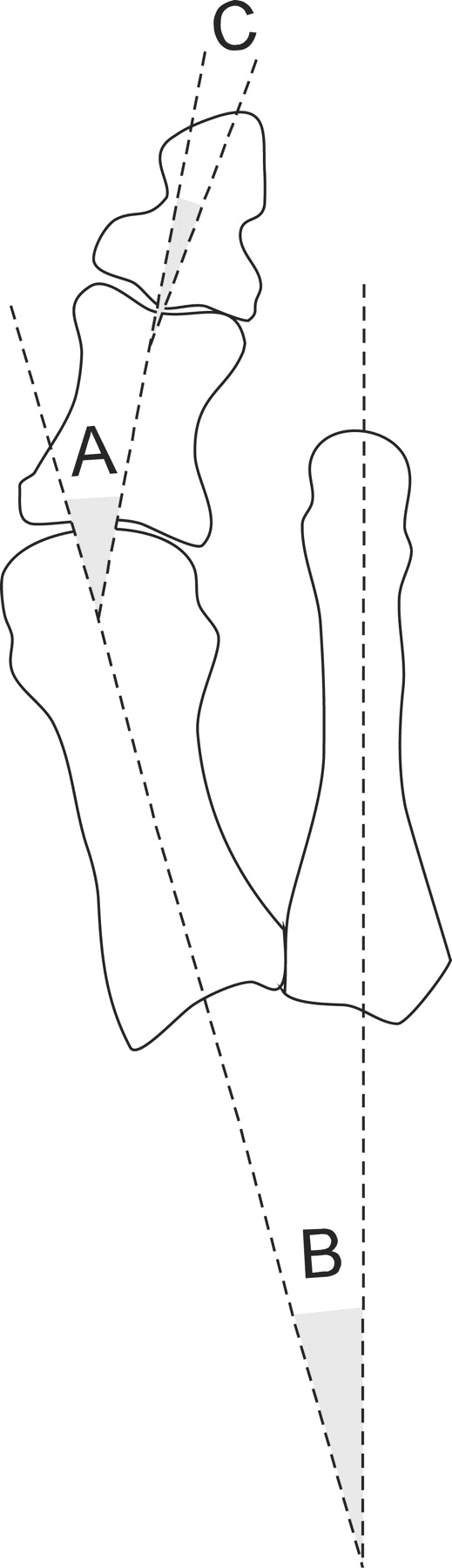 Messungen aus Röntgenstrahlen. (A) Winkel des Hallux abductus; (B) Intermetatarsalwinkel; (C) Winkel des Hallux Interphalangeal Abductus.