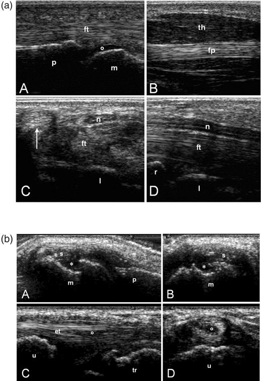 (a) US images taken during the practical session with healthy subjects. (A) Longitudinal volar scan of a metacarpophalangeal joint. (B) Longitudinal scan of the thenar eminence. Transverse (C) and longitudinal (D) volar scans of the carpal tunnel. m, metacarpal head; p, proximal phalanx; o, articular cartilage; ft, finger flexor tendons; fp, flexor pollicis longus tendon; th, muscles of the thenar eminence; l, lunate bone; n, median nerve; arrow, flexor carpi radialis tendon; r, radius. (b) US images taken during the practical session with patients with rheumatoid arthritis. (A, B) Metacarpophalangeal joint. Longitudinal (A) and transverse (B) dorsal scans showing synovial hypertrophy (s) and a bone erosion (*) of the metacarpal head (m). p = proximal phalanx. (C, D) Wrist. VI compartment of the extensor tendons. Longitudinal (C) and transverse (D) lateral scans showing a partial rupture (o) of the extensor carpi ulnaris tendon (et). u, ulna; tr, triquetrum.