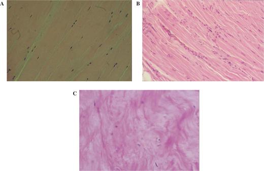 Histopathological changes seen in tendinopathy demonstrating a lack of an inflammatory response. (A) Normal tendon with scattered elongated cells. (B) Slightly pathological tendinous tissue with islands of high cellularity and initial disorganization. (C) Highly degenerated tendon with some chondroid cells; distinct lack of inflammatory infiltrate. (Images reproduced from Benazzo F, Mosconi M, Maffulli N. Hindfoot tendinopathies in athletes. In: Maffulli N, Renström, Leadbetter WB, ed. Tendon injuries basic science and clinical medicine, Springer, London, 2005, with kind permission of Springer Science and Business Media.) This figure may be viewed in colour as supplementary data at Rheumatology Online.