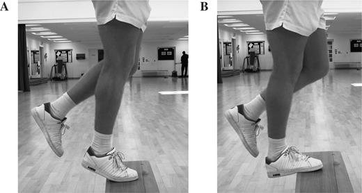 Eccentric loading of the right gastrocnemius muscle/Achilles tendon showing the starting position (A) and finishing position (B). Three sets of 15 repetitions are performed twice per day, 7 days per week for 12 weeks. The exercises are repeated with the knee flexed to load the soleus muscle. The contralateral leg performs recovery to the starting position.