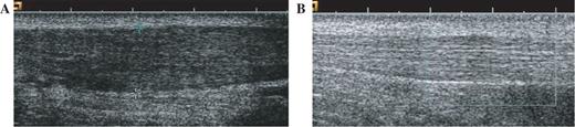 Ultrasound appearance of Achilles tendon before and after a long-term eccentric loading programme. (A) Typical appearance of a hypoechoic Achilles tendon prior to commencing an eccentric loading programme. (B) The appearance after a long-term eccentric loading programme. Loss of hypoechoic appearance and reduced tendon thickening are demonstrated. (Reproduced from Öhberg L, Lorentzon R, Alfredson H. Eccentric training in patients with chronic Achilles tendinosis: normalised tendon structure and decreased thickness at follow up. Br J Sports Med 2004;38:8–11 with permission from the BMJ Publishing Group.)