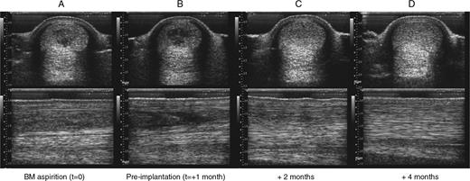 Sequential transverse (top row) and longitudinal (bottom row) ultrasonographs taken from a horse treated by the stem cell technique. (A) At bone marrow aspiration. (B) One month after aspiration, just prior to implantation. (C) One month post-implantation. (D) Three months post-implantation. Note the rapid infilling of the lesion within 1 month of implantation, whereas there was little change in the lesion in the preceding month. (Image reproduced from Smith RKW, Webbon PM. Harnessing the stem cell for the treatment of tendon injuries: heralding a new dawn? Br J Sports Med 2005;39:582–4, with permission from the BMJ Publishing Group.)