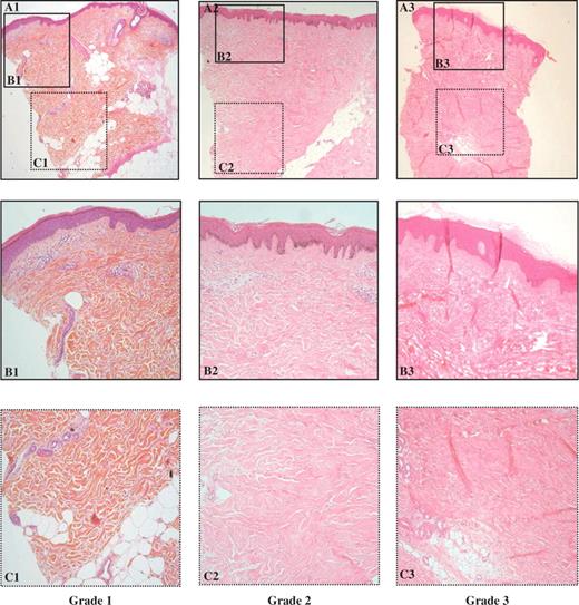  Histological patterns of skin fibrosis on standard optic microscopy analysis. A = 40×, B and C = 200×, using haematoxylin–eosin–safran trichrome staining. Three increasing grades (A1, A2, A3) of fibrosis were defined as in Table 2 . 