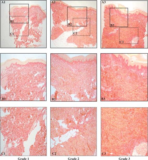  Histological patterns of skin fibrosis on standard optic microscopy analysis. A = 40×, B and C = 200×, using Sirius red staining specific for fibrillar collagens. Three increasing grades (A1, A2, A3) of fibrosis were defined as in Table 2 . 