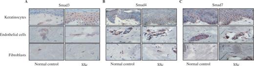  Immunohistochemistry of Smad proteins. Tissues sections derived from normal and SSc skin tissue were stained for Smad3 (A) , Smad4 (B) and Smad7 (C) by immunoperoxidase method. The expression and the localization of these proteins were analysed in keratinocytes (upper panel), endothelial cells (middle panel) and fibroblasts (lower panel). Serial sections were counterstained with haematoxylin–eosin. (Magnification 100×). 