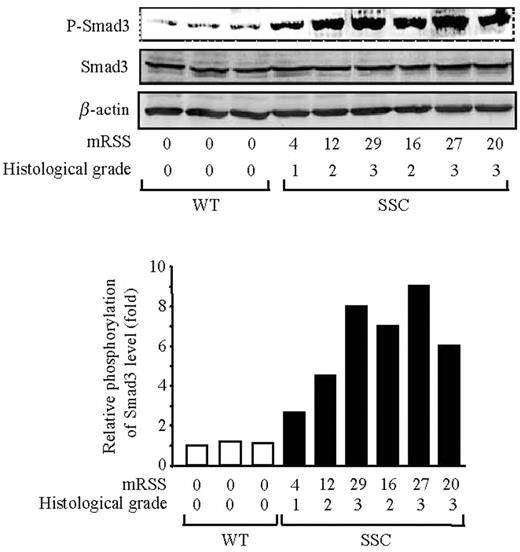  Correlation between Smad3 phosphorylation levels in fibroblast cultures and the mRSS of donor patients measured by the clinician at time of skin biopsy and the histological grade of fibrosis (defined in Table 2 ). Western analysis of whole-cell lysates for phospho-Smad3, Smad3 and β-actin levels. Lane 1–3: normal fibroblasts, lane 4–9: SSc fibroblasts. The ratio of phospho-Smad3 to Smad3 is plotted in the diagram as one representative experiment of three separate experiments (lower panel). 