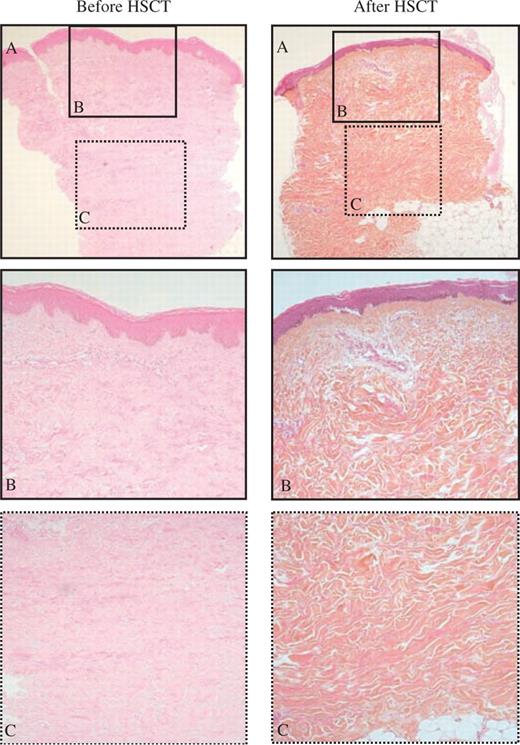 Regression of the SSc skin fibrotic process after autologous haematopoietic stem cell transplantation. Typical skin sections stained with haematoxylin–eosin–safran as observed in patient 27 before (biopsy number 44) and after (biopsy number 45) HSCT.