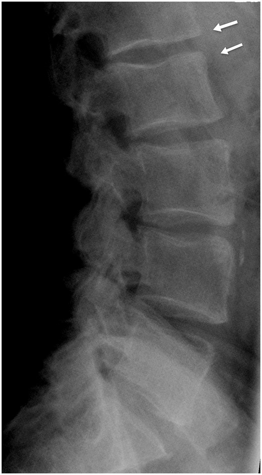 The lateral radiograph of the lumbar spine of a patient from the dataset