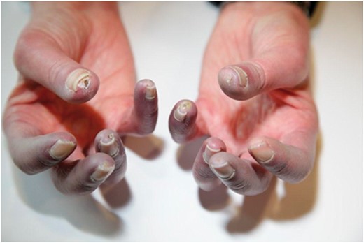 Acrocyanosis in the digits of a patient with limited cutaneous systemic sclerosis