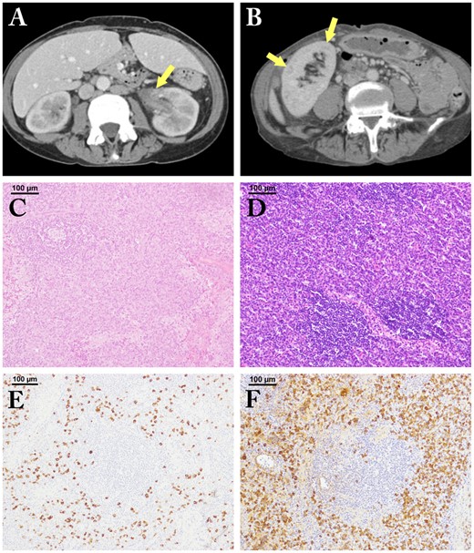 The imaging findings of kidney lesions and histopathological findings of lymph node lesions