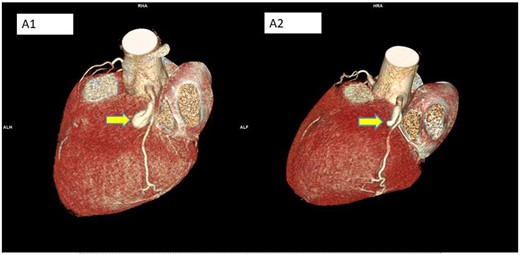 Three-dimensional images of the aneurysm at the start and after 4 months of treatment