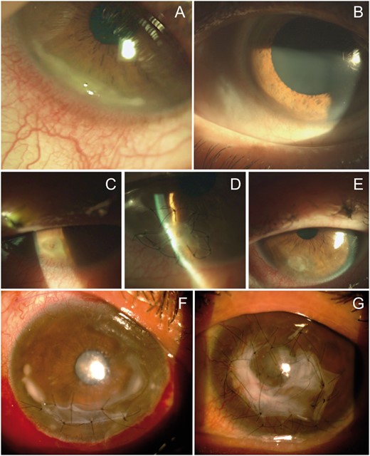 Patient 1. (A) Slit lamp photograph of inferotemporal PUK of the right eye with a crescent-shaped ulcer, stromal infiltration and adjacent vascular congestion. (B) Slit lamp photograph at last follow-up visit: complete healing of the cornea. (C–E) Patient 2. (C) PUK complicated with corneal perforation. (D) Initial repair using sutured multilayer AMT. (E) At the 1 month postoperative visit: suture removal and corneal integration of AMT. (F, G) Patient 4. (F) Right eye, with extensive PUK with sutured inlay AMT to prevent corneal perforation. (G) Left eye, with extensive crescent-shaped ulcers covered with AMT.