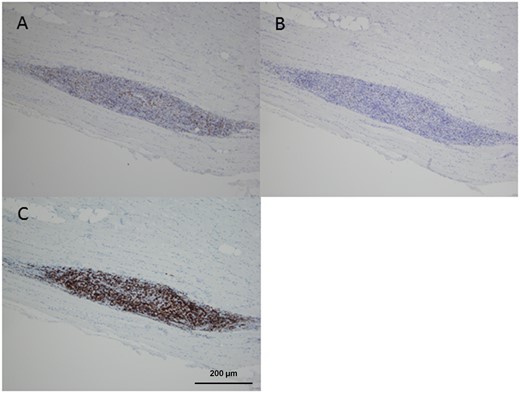Immunohistochemical staining of muscle biopsy from patient 3 (A) anti-CD4, (B) anti-CD8 and (C) anti-CD20 antibodies. Magnification ×100.