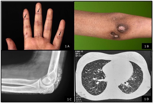 Fig. 1 Clinical and radiological features in the index case with JDM