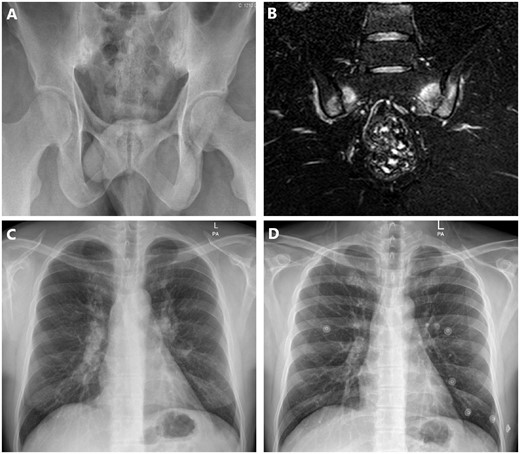 Sacroiliitis in sarcoidosis mimicking ankylosing spondylitis