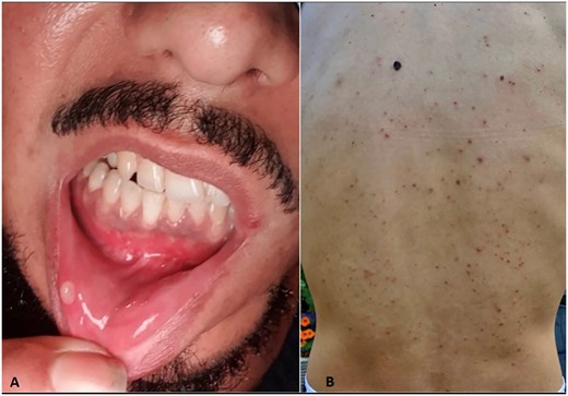 (A) Several large and herpetiform mouth ulcers. (B) Acneiform rash on the back.