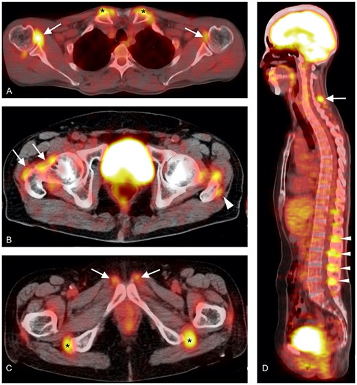Characteristics of inflammatory lesions detected by FDG-PET/CT