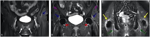 Characteristics inflammatory lesions detected by MRI