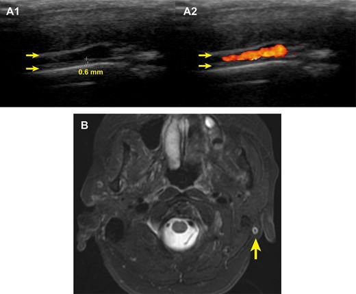 Wall thickening of the left posterior auricular artery
