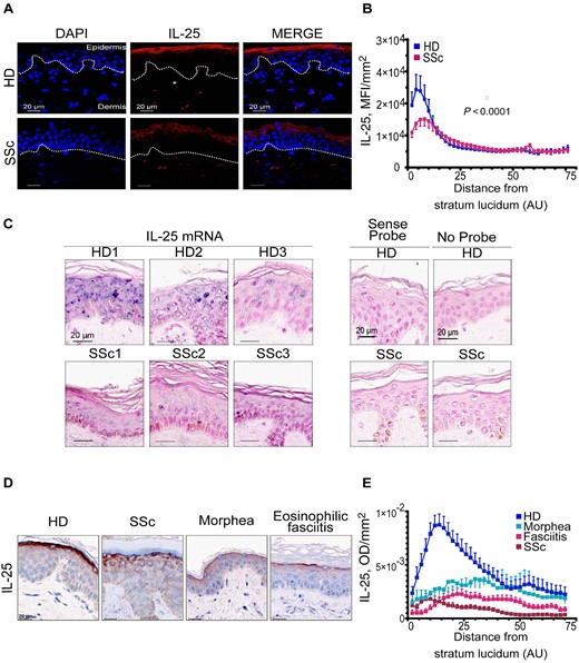 IL-25 expression is decreased in the epidermis of SSc and scleroderma-like disorders