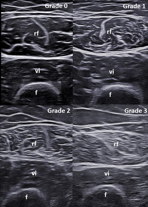 Modified version of the scale by Heckmatt et al. for the visual semi-quantitative assessment of muscle echogenicity