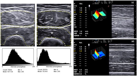 Muscle echogenicity (i.e. semi-quantitative evaluation and grayscale analysis with histograms) and SWE in SLE patients and healthy subjects