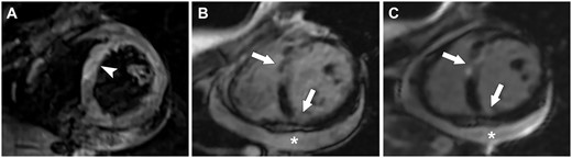 Eosinophilic granulomatosis with polyangiitis (EGPA)-related cardiomyopathy